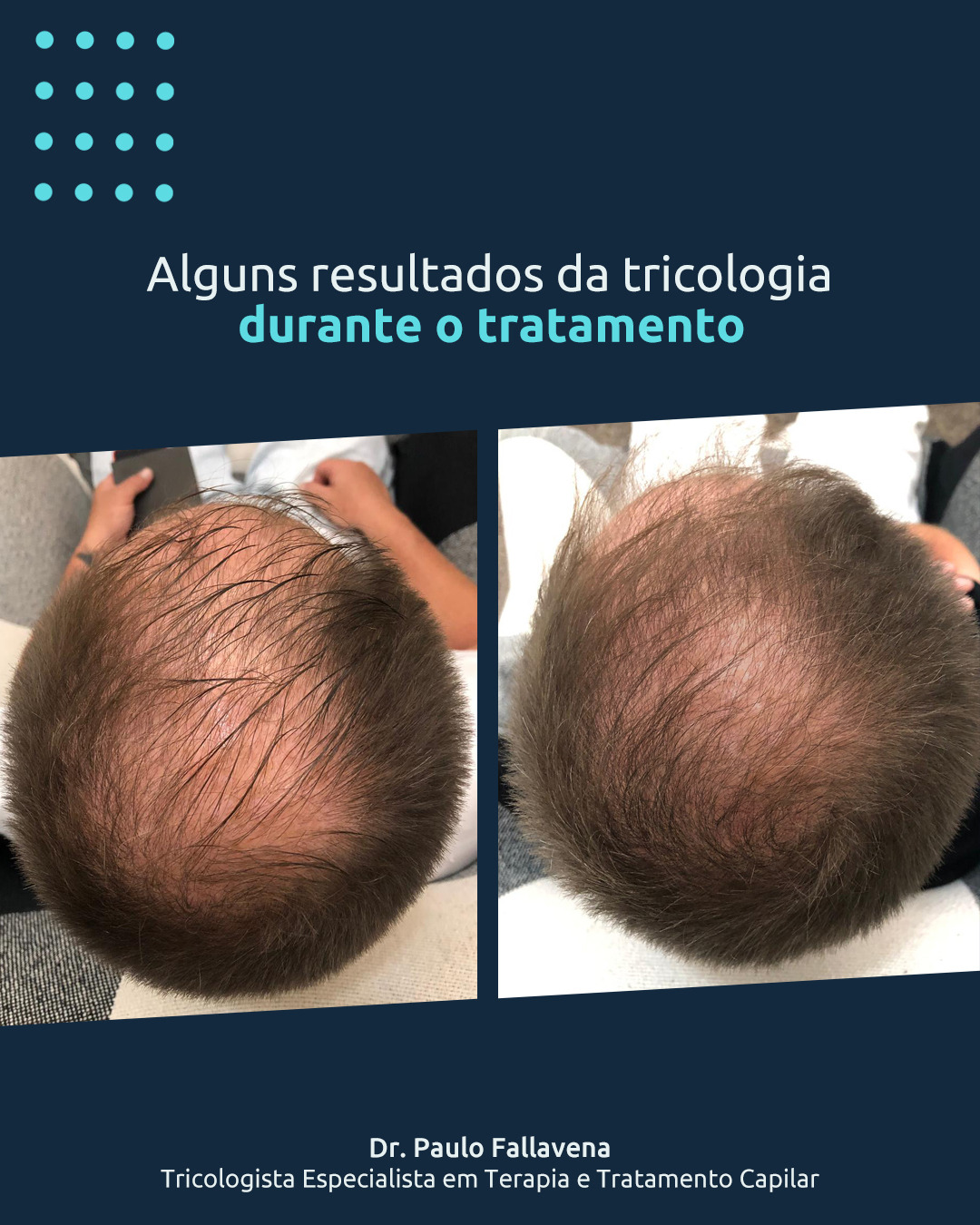 Comparação fotográfica da região do vértex