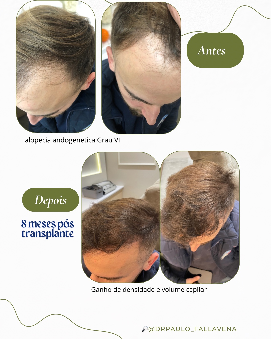 Comparação antes e após transplante capilar